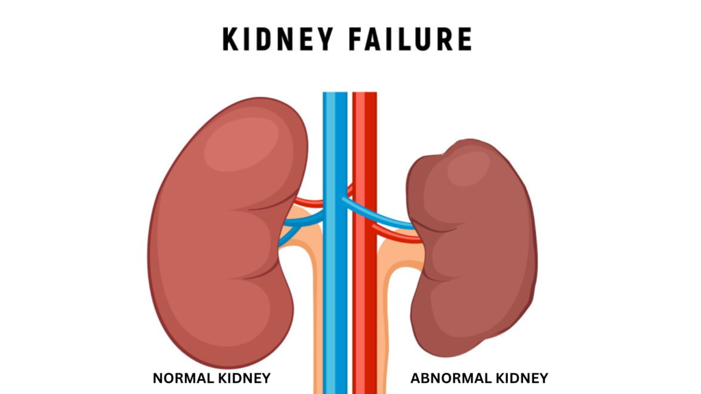 Kidney failure. Cost of kidney failure. 
Image shows a shrunken left kidney consistent with chronic kidney disease