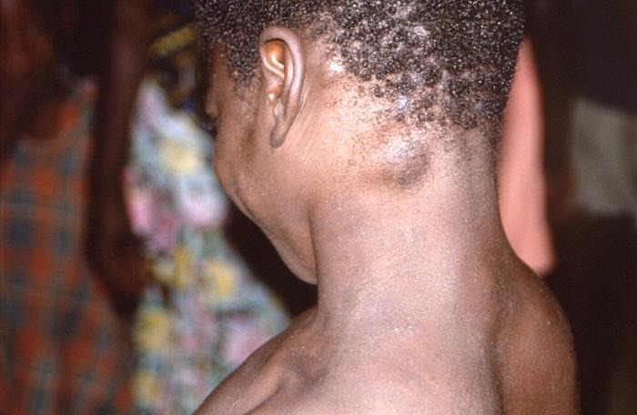 Enlarged lymph node, an Mpox (Monkeypox) symptom