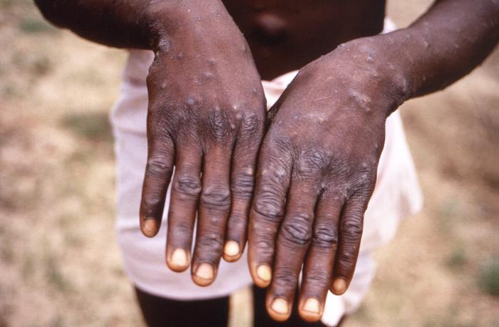 Mpox(Monkeypox) symptom rash of the hand