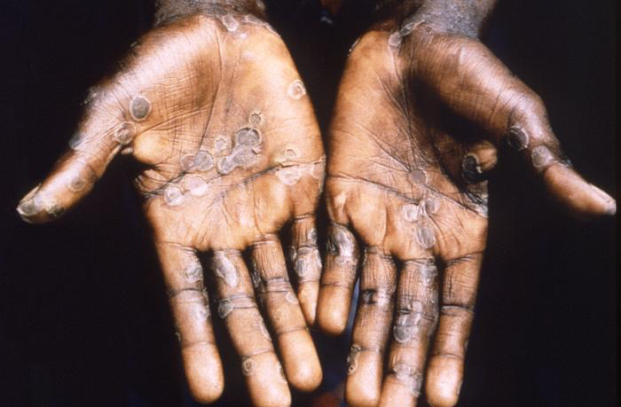 Mpox(Monkeypox) symptom rash of the palm of the hand